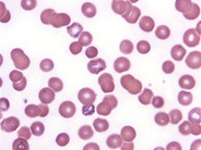 Basophilic Stippling - 3.