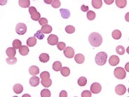 Basophilic Stippling - 4.