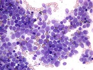 Acute promyelocytic leukemia - 1.