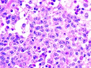 Langerhans cell histiocytosis - 3.