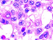 Langerhans cell histiocytosis - 7.