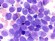 Look-alikes: APL vs Reactive Marrow - 1.