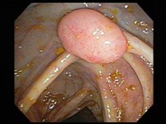 Follicular lymphoma (grade 1/3) in a hepatic flexure polyp - 1.