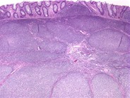 Follicular lymphoma (grade 1/3) in a hepatic flexure polyp - 2.