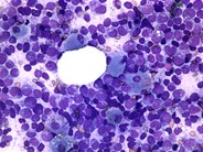 PseudoGaucher-cells--4