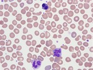 Hemolytic disease of the newborn secondary to ABO incompatibility - 1.