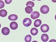 Malaria - 1.