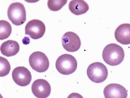 Malaria - 2.