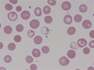 Siderocytes - 1.