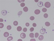 Siderocytes - 3.