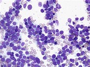 Precursor T-cell lymphoblastic leukemia - 1.