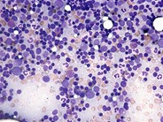 Post-BMT aspirate - 1.