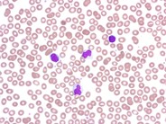 Adult T-cell leukemia/lymphoma, smoldering variant - 1.