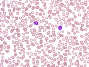 Adult T-cell leukemia/lymphoma, smoldering variant - 2.
