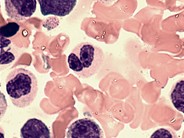 Dysgranulopoiesis - 3.