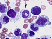 Dysgranulopoiesis - 4.