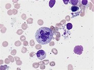 Dysgranulopoiesis - 5.