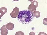 Dysgranulopoiesis - 6.