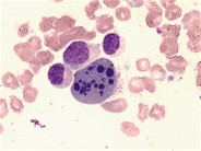 Dysgranulopoiesis - 8.