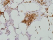 Indolent systemic mastocytosis - 2.