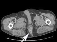 Perirectal abscess - 1.