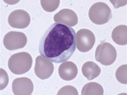 Atypical lymphocytes - 1.