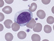Atypical lymphocytes - 2.