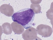Atypical lymphocytes - 3.