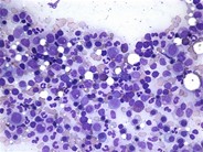 Normal adult bone marrow aspirate - 1.