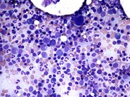 Normal pediatric bone marrow aspirate - 1.
