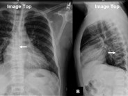 Fish mouth vertebrae and sickle cell spine - 1.