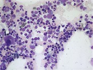 Reactive bone marrow aspirate - 1.
