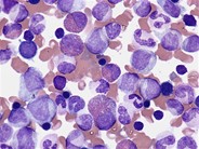 Eosinophilia in the bone marrow - 1.