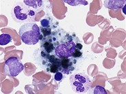 Debris laden histiocyte - 1.