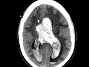 CNS hemorrhage - 1.