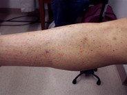 petechiae-1