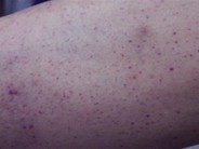 Petechiae - 2.