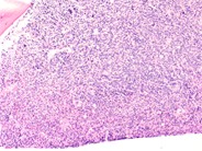 Recurrent AML following peripheral stem cell transplant - 5.