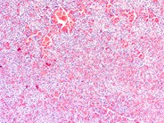 Hairy cell leukemia involving the spleen - 2.