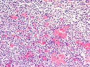 Hairy cell leukemia involving the spleen - 3.