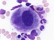 Unilobed megakaryocyte - 1.