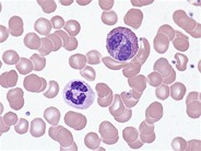 Look-alikes: eosinophil vs. neutrophil - 1.