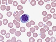 Lymphoplasmacytoid lymphocyte - 1.
