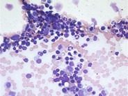 Lymphocytosis - bone marrow - 1.