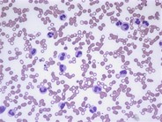 Neutrophilia - 1.