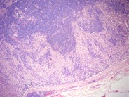 Dermatopathic lymphadenopathy - 2.