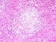 Systemic mastocytosis involving lymph nodes - 2.