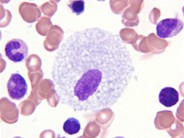 Bone marrow involvement in Niemann Pick disease - 3.