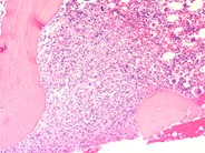 HIV-related marrow granuloma - 1.