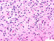 HIV-related marrow granuloma - 3.